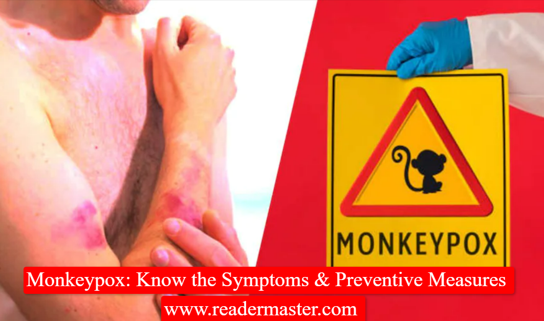 Monkeypox - Know the Symptoms & Preventive Measures